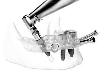 implantes dentales en Valdemoro - Cirugía guiada
