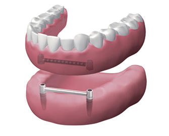 implantes dentales en Valdemoro - Dentadura extraíble