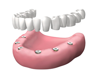 implantes dentales en Valdemoro - Dentadura fija