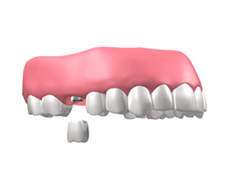 implantes dentales en Valdemoro - Implantes unitarios