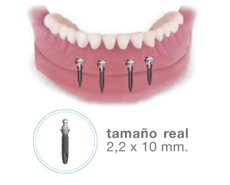 implantes dentales en Valdemoro - Mini implantes
