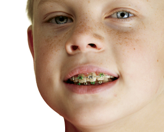 Ortodoncia niños