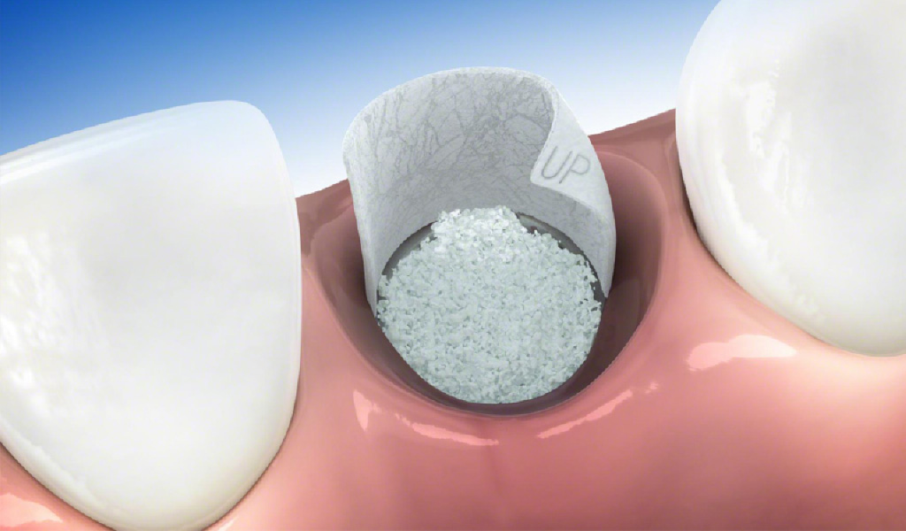 implantes dentales en Valdemoro
