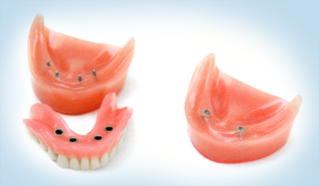 implantes dentales en Valdemoro