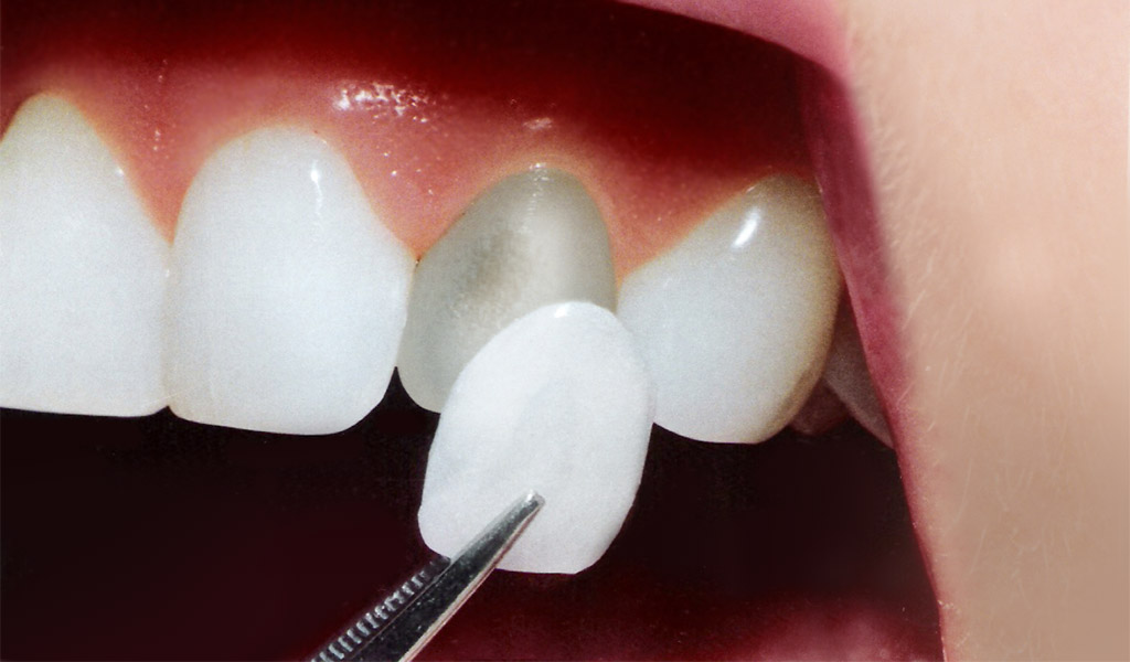 estética dental en Valdemoro