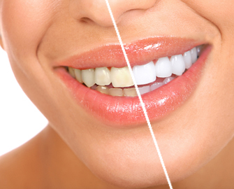 Blanqueamiento dental
