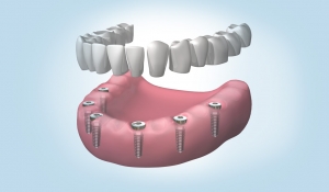 implantes dentales en Valdemoro