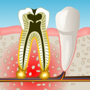 endodoncia en Valdemoro
