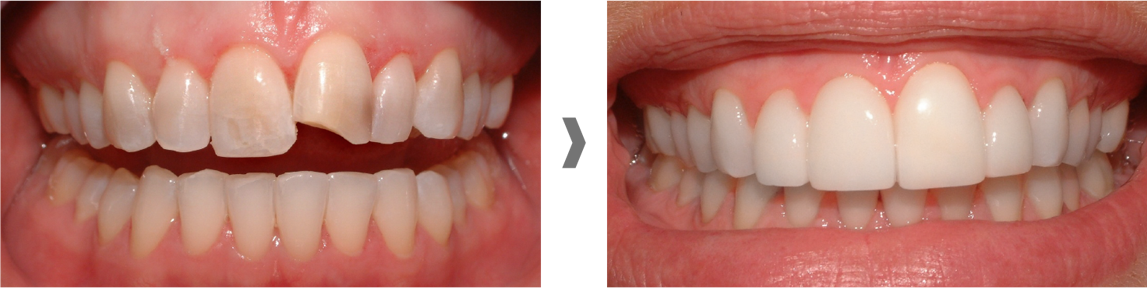 Carillas dentales sin rebajar el diente en Valdemoro
