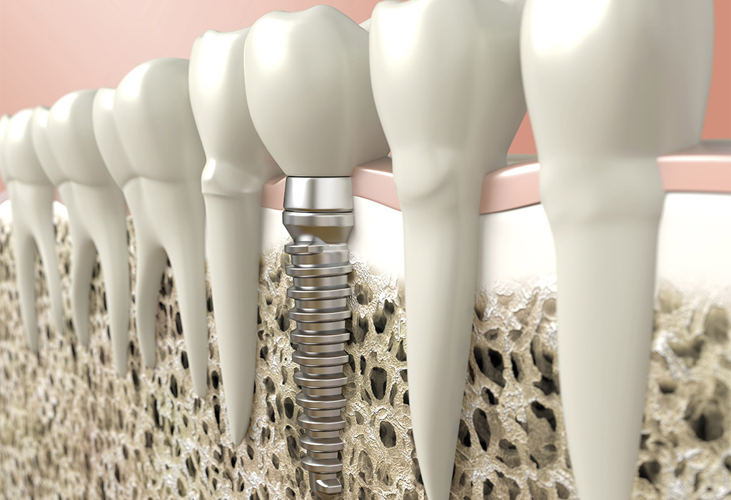 Implantología dental en Valdemoro