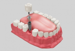 Implantes dentales de carga inmediata en Valdemoro