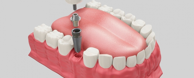Implantes dentales de carga inmediata en Valdemoro