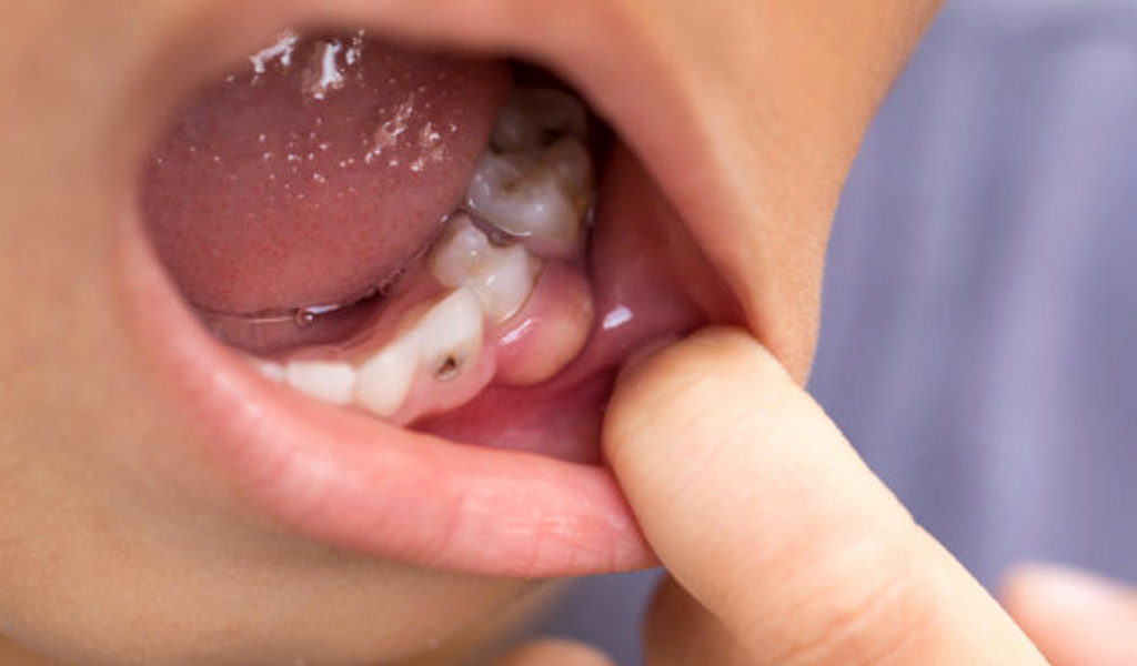 Urgencias dentales en Valdemoro
