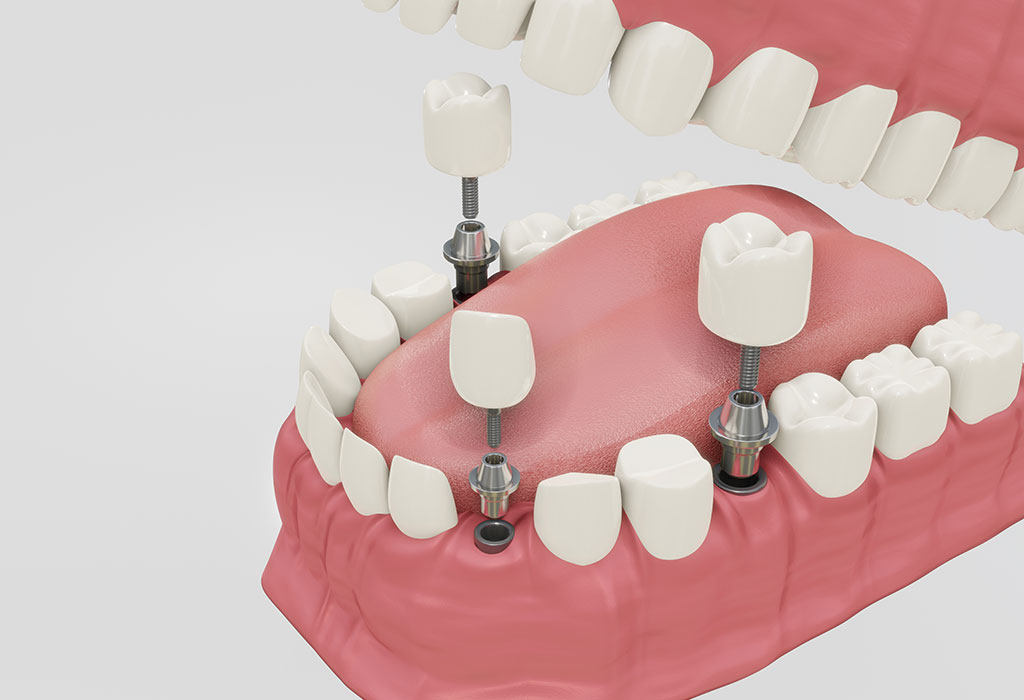 Prótesis fija sobre implantes dentales en Valdemoro
