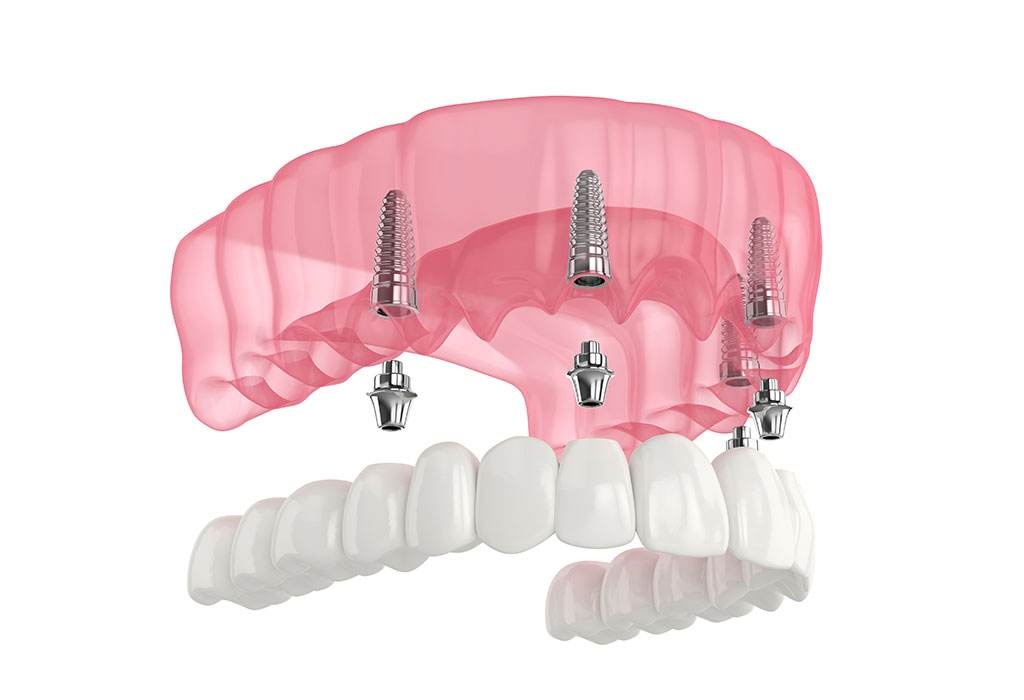 Prótesis fija sobre implantes dentales en Valdemoro